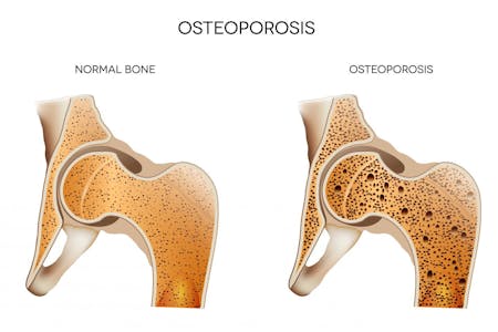 How To Prevent Osteopenia