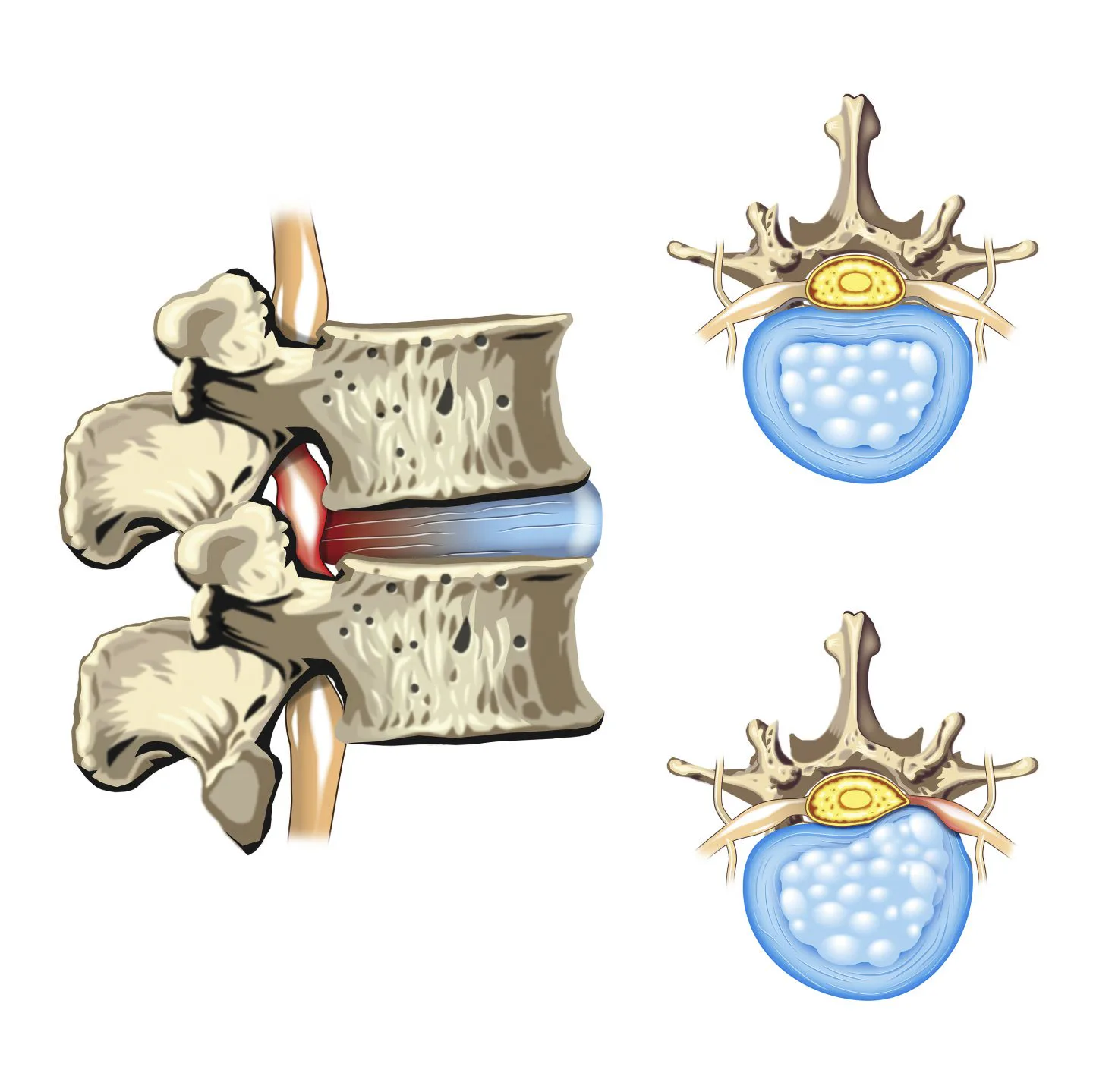 Spinal Disc Health