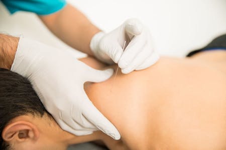 Dry Needling - Physical and Sports Therapy Services - Payson, Springville,  Orem, UT