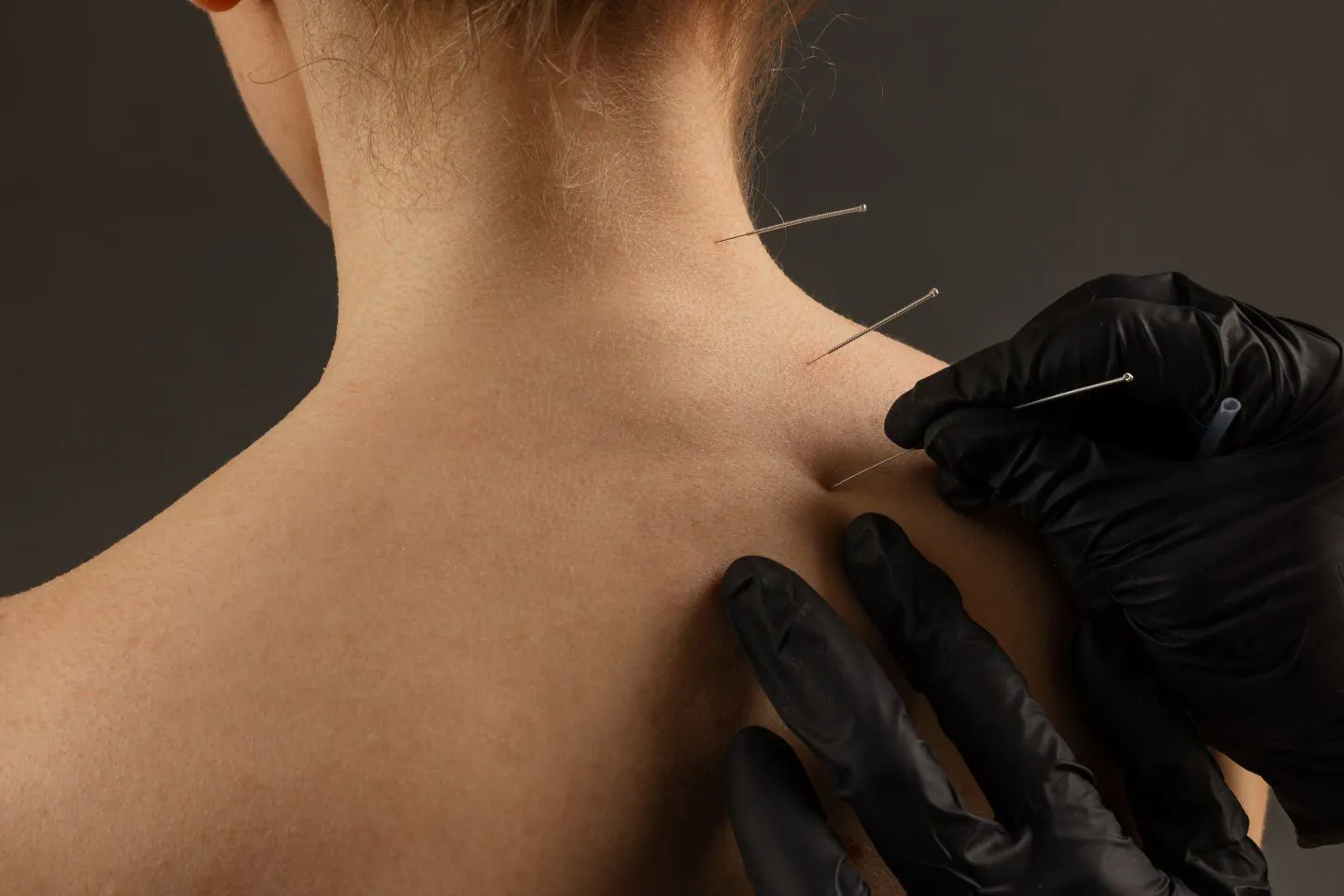 Dry Needling