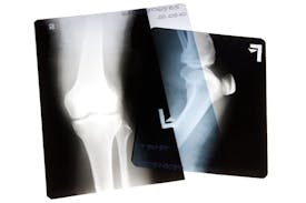Joint Replacement Academy | Roseville CA | Folsom CA