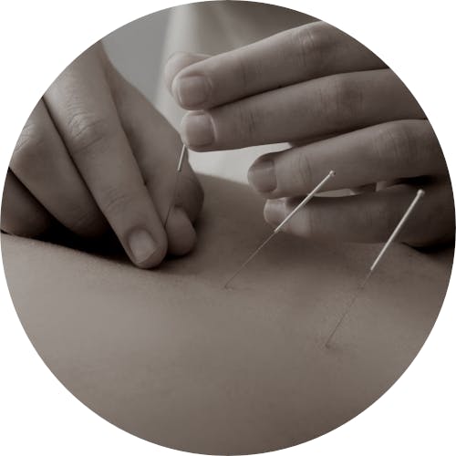 All Therapy Middleton, DE Dry Needling
