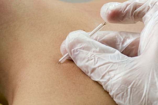 Dry Needling - Movement Specialists Physical Therapy - Mandeville and  Metairie LA